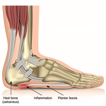 Plantar Fasciitis